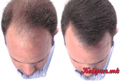 50% попуст на ласерски третман за обновување на коса за мажи и жени во „Derma Lux“ во вредност од 1000ден. за само 499ден.